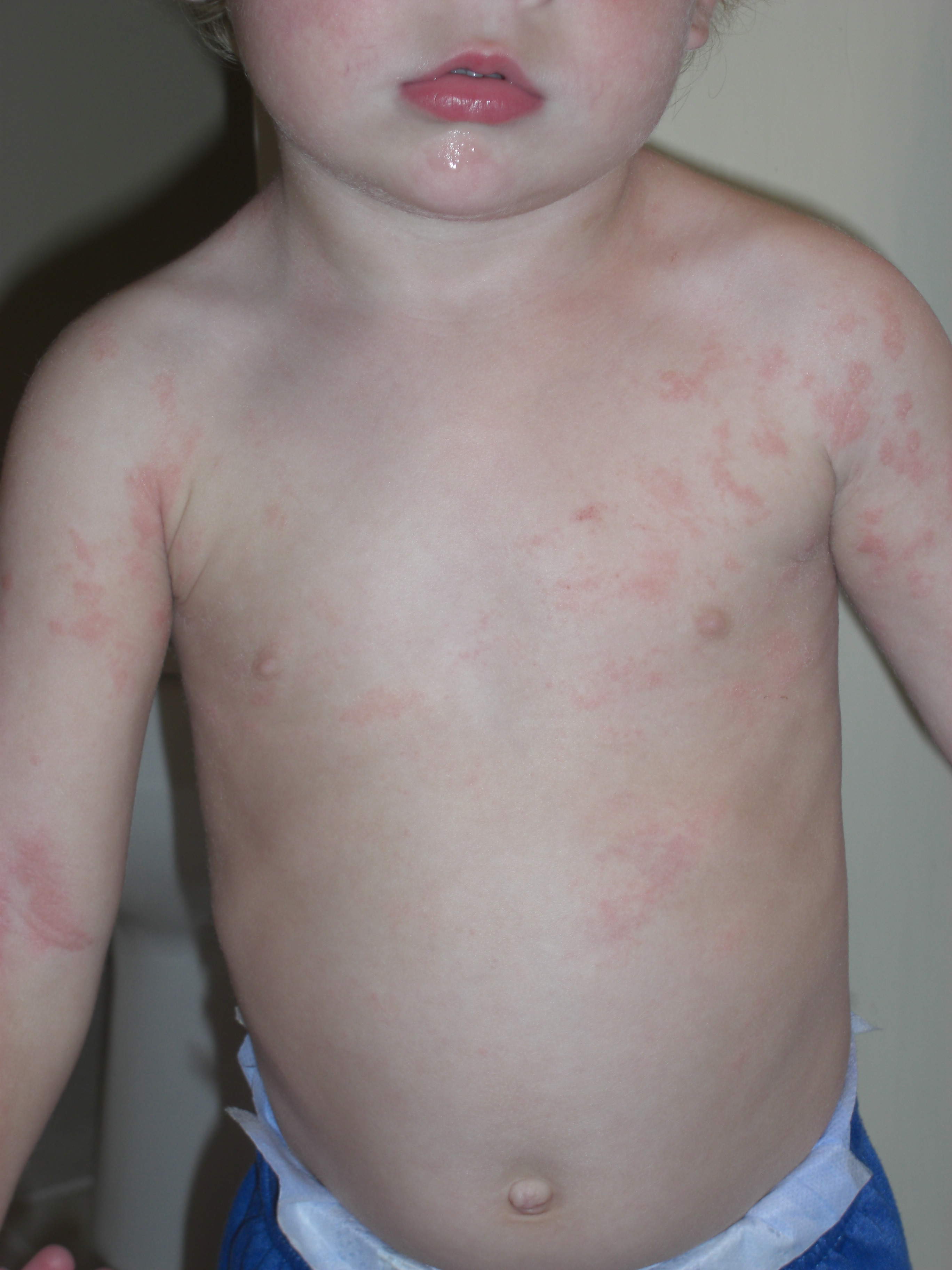 toddler skin rashes #9